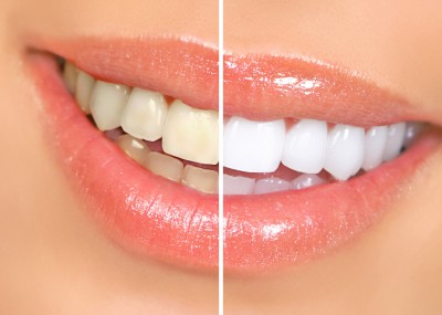 Teeth Whitening Study