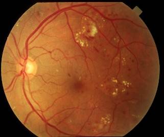 "Diabetic changes to the back of the eye."