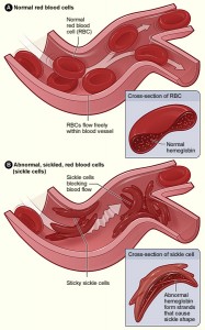 Abnormal sickled red blood cells